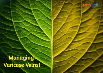 Varicose Veins